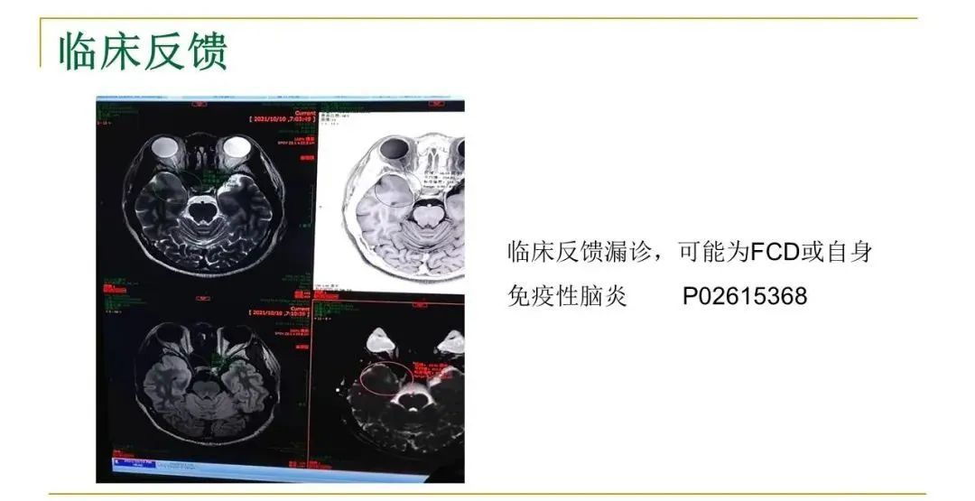 影像PPT - 【PPT】影像报告注意事项汇总(神经系统)-4