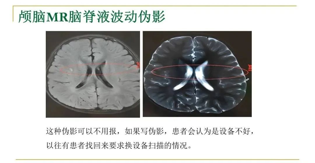 影像PPT - 【PPT】影像报告注意事项汇总(神经系统)-3