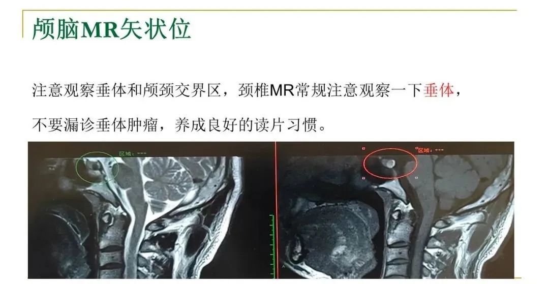 影像PPT - 【PPT】影像报告注意事项汇总(神经系统)-5