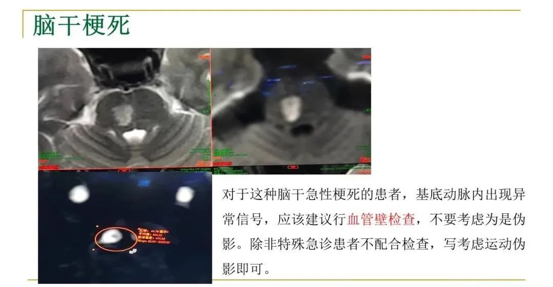 影像PPT - 【PPT】影像报告注意事项汇总(神经系统)-6