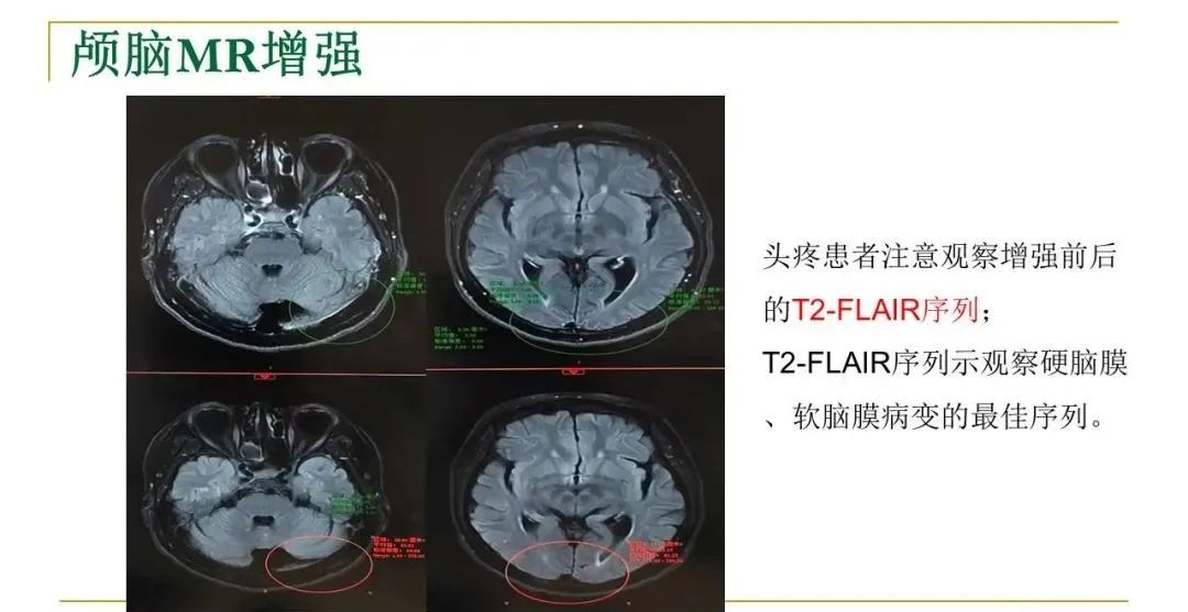 影像PPT - 【PPT】影像报告注意事项汇总(神经系统)-7