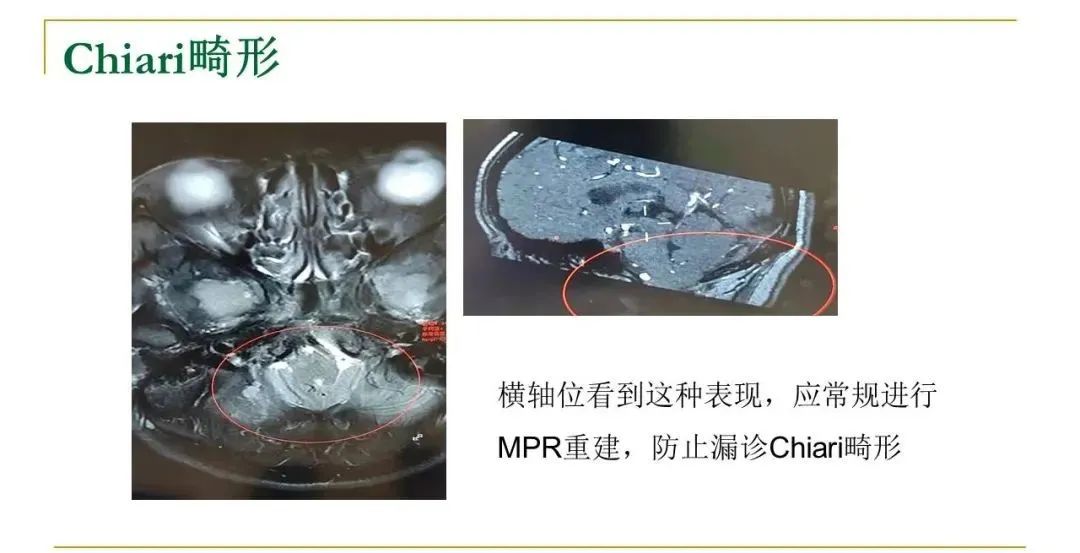 影像PPT - 【PPT】影像报告注意事项汇总(神经系统)-8
