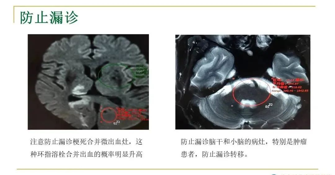 影像PPT - 【PPT】影像报告注意事项汇总(神经系统)-10