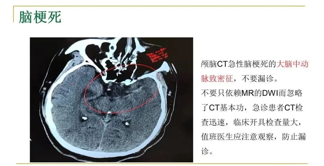 影像PPT - 【PPT】影像报告注意事项汇总(神经系统)-12