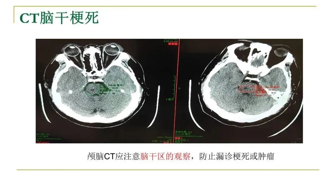 影像PPT - 【PPT】影像报告注意事项汇总(神经系统)-13