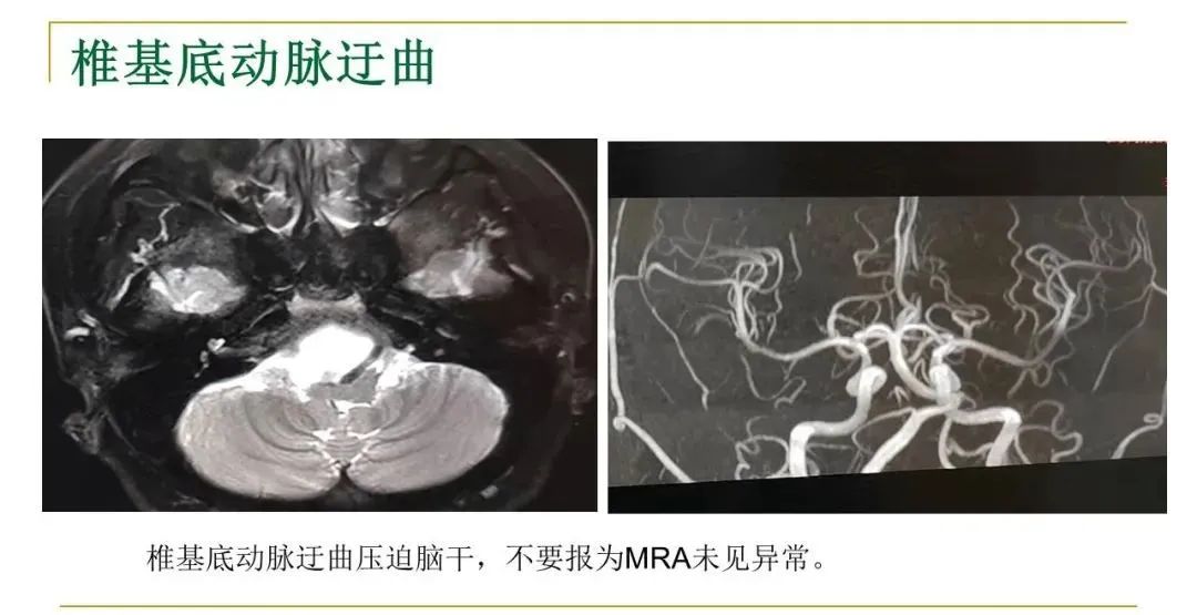 影像PPT - 【PPT】影像报告注意事项汇总(神经系统)-16