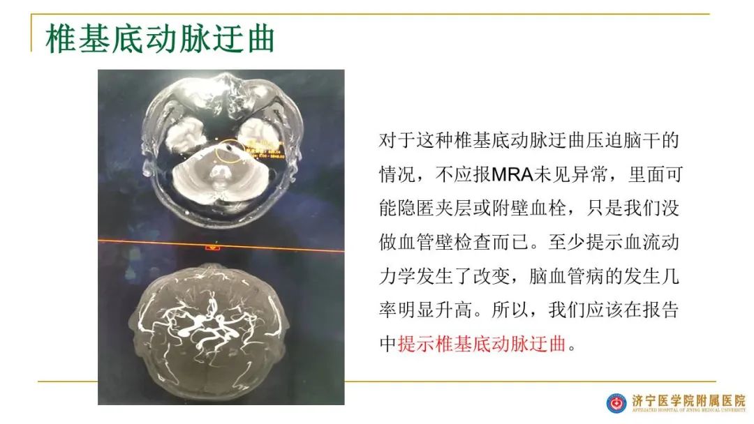 影像PPT - 【PPT】影像报告注意事项汇总(神经系统)-17