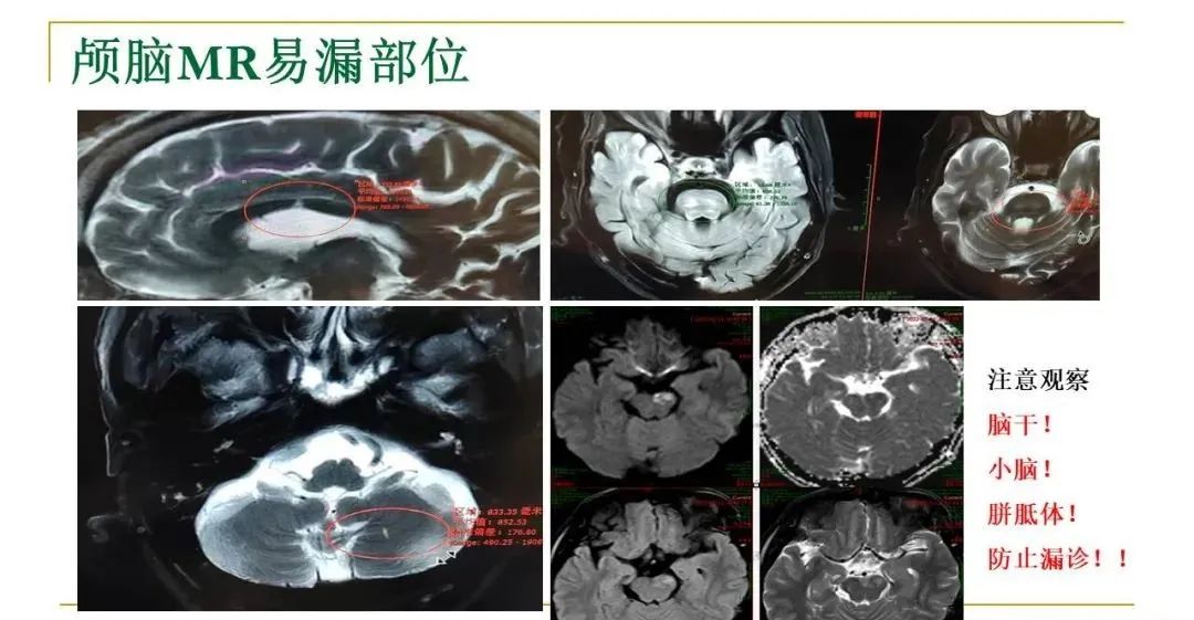 影像PPT - 【PPT】影像报告注意事项汇总(神经系统)-18