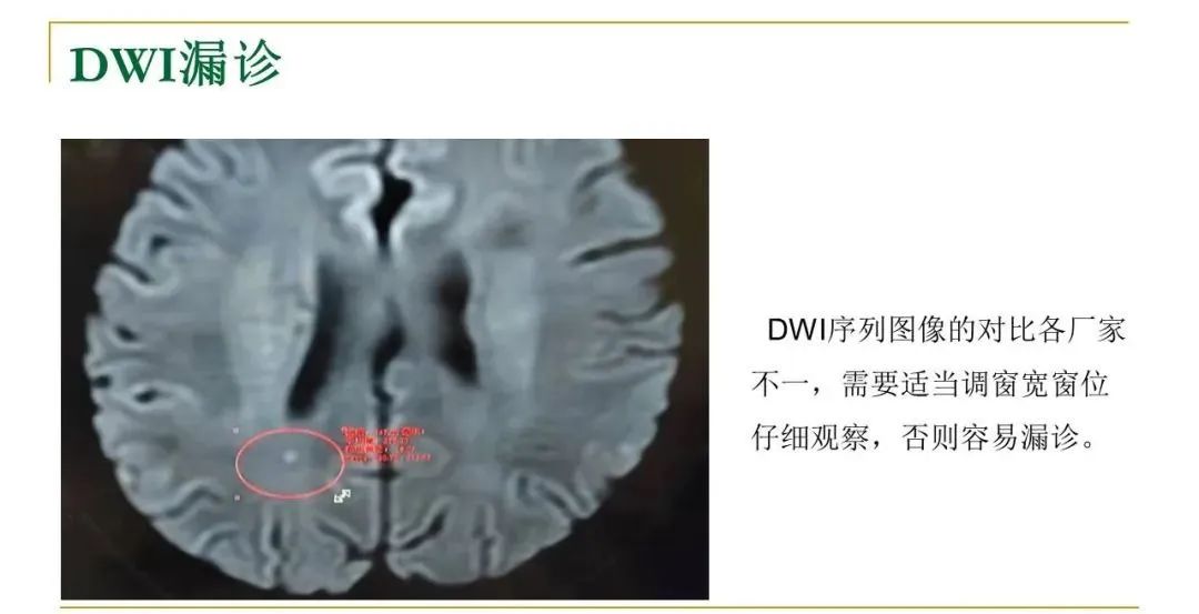 影像PPT - 【PPT】影像报告注意事项汇总(神经系统)-19