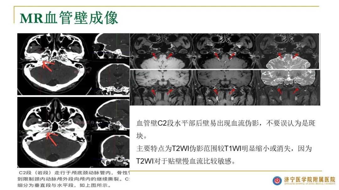 影像PPT - 【PPT】影像报告注意事项汇总(神经系统)-20