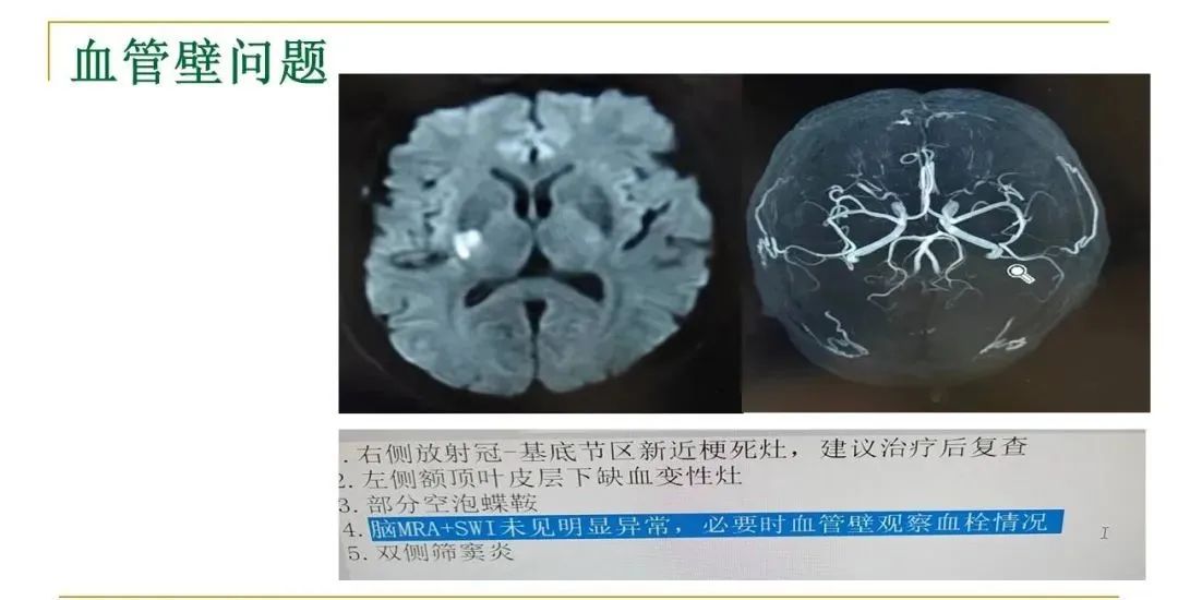 影像PPT - 【PPT】影像报告注意事项汇总(神经系统)-21