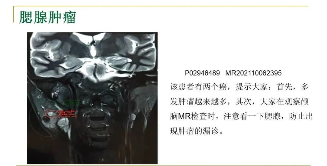 影像PPT - 【PPT】影像报告注意事项汇总(神经系统)-24