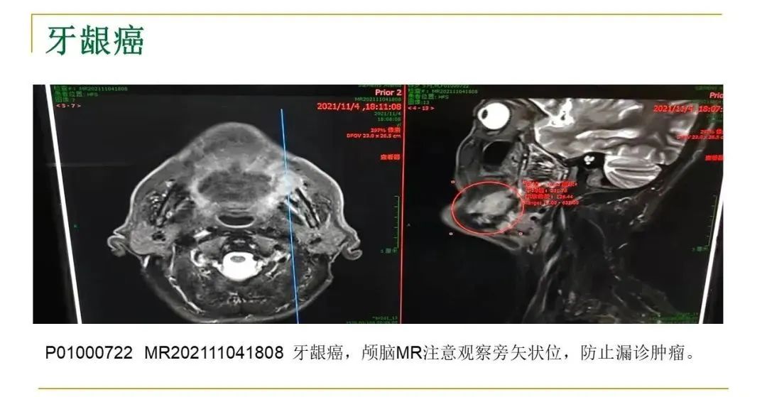 影像PPT - 【PPT】影像报告注意事项汇总(神经系统)-25