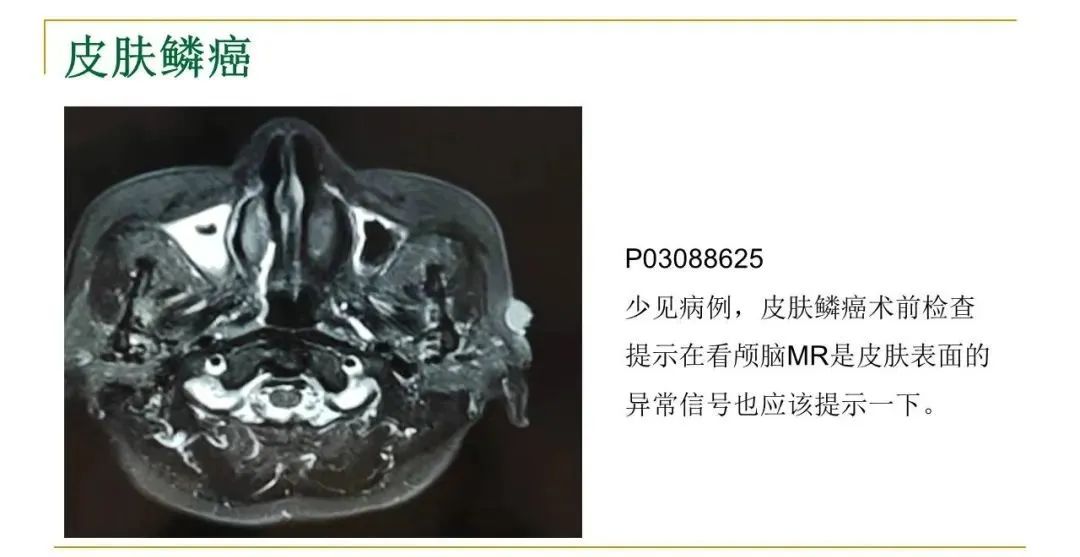 影像PPT - 【PPT】影像报告注意事项汇总(神经系统)-26