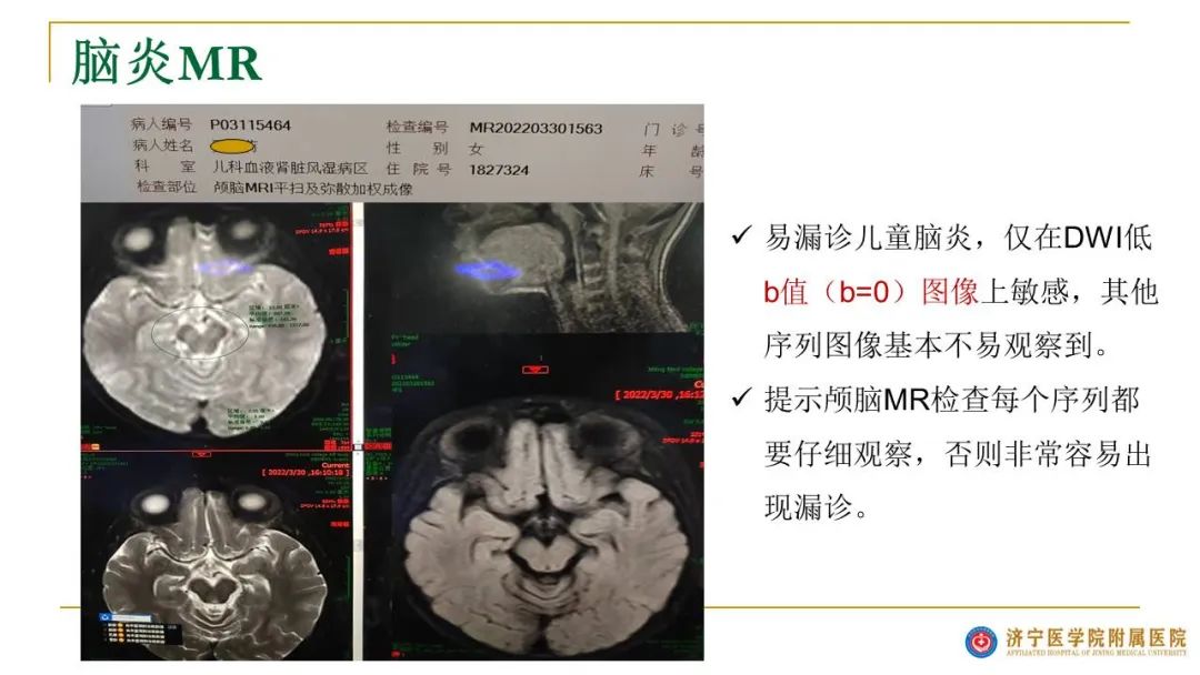 影像PPT - 【PPT】影像报告注意事项汇总(神经系统)-28