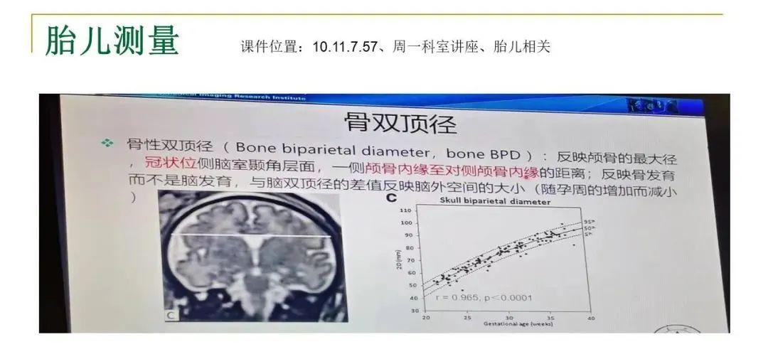 影像PPT - 【PPT】影像报告注意事项汇总(神经系统)-30
