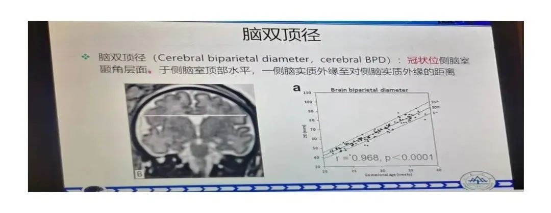 影像PPT - 【PPT】影像报告注意事项汇总(神经系统)-31