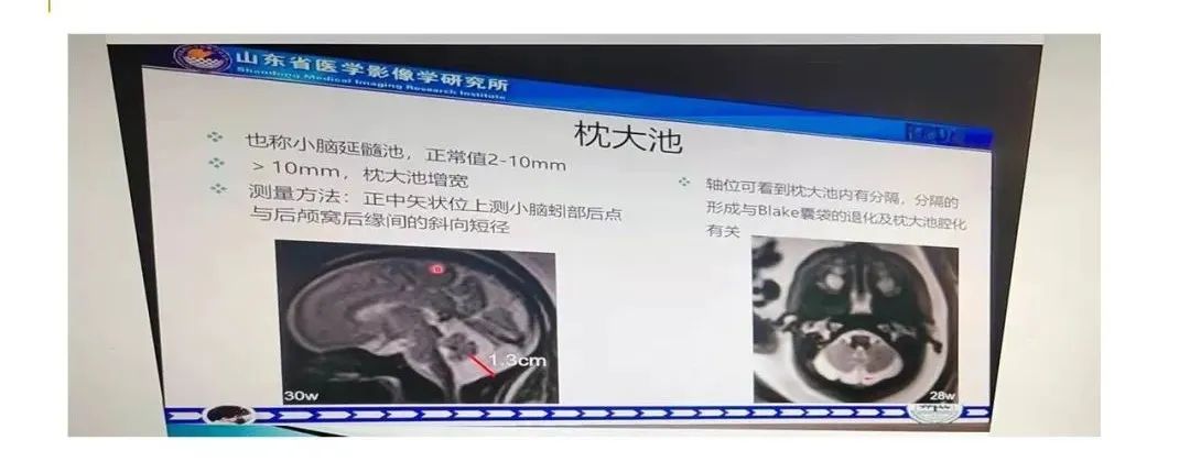 影像PPT - 【PPT】影像报告注意事项汇总(神经系统)-32