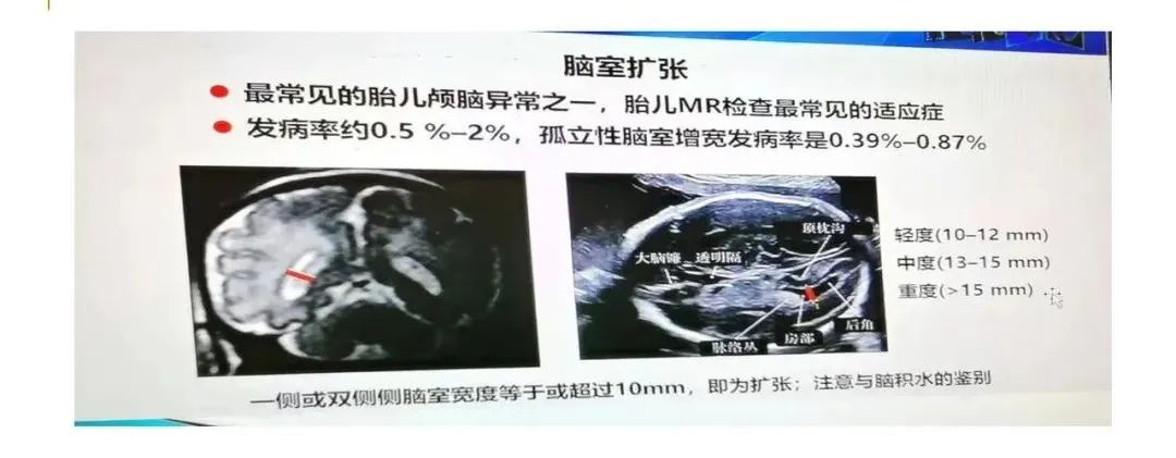 影像PPT - 【PPT】影像报告注意事项汇总(神经系统)-33