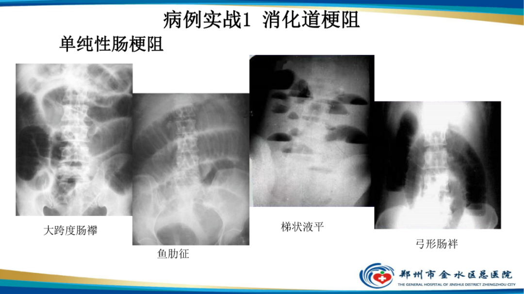 影像PPT - 【PPT】常见急腹症的影像学诊断-12
