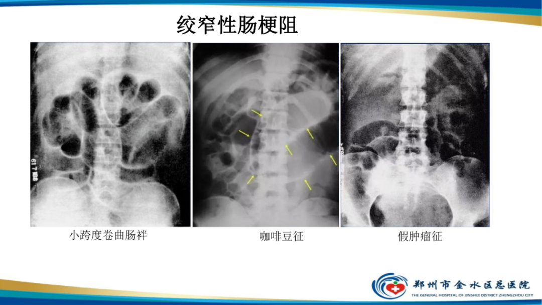 影像PPT - 【PPT】常见急腹症的影像学诊断-13