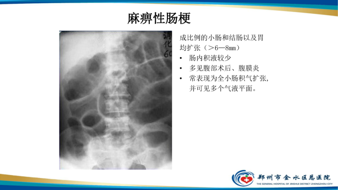 影像PPT - 【PPT】常见急腹症的影像学诊断-14