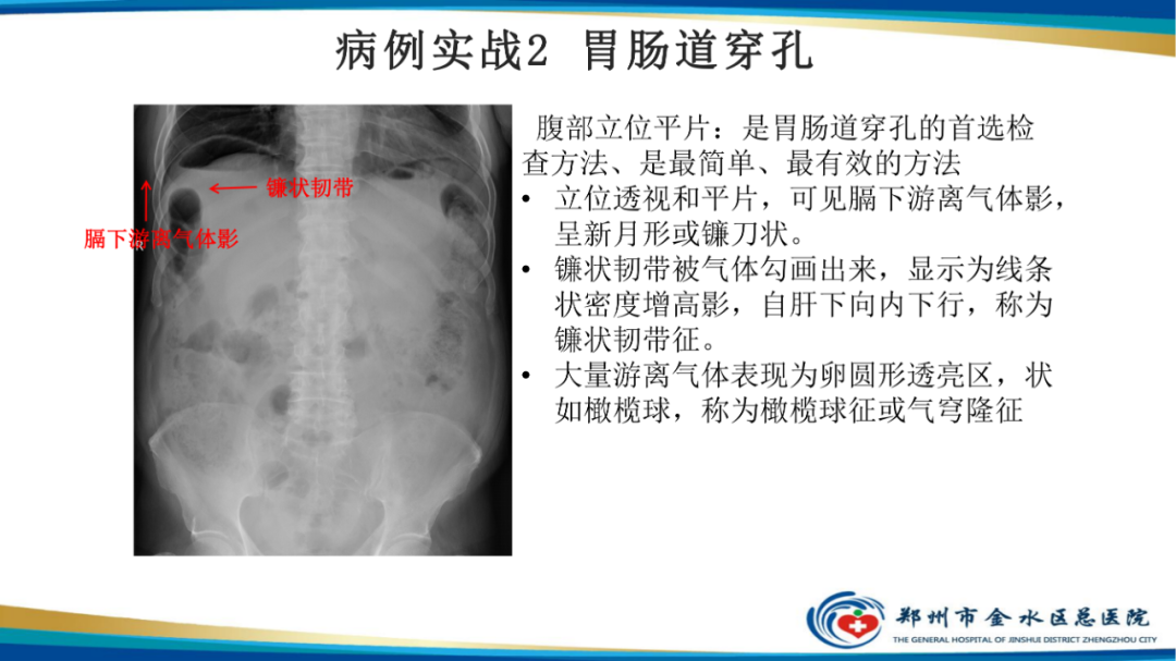 影像PPT - 【PPT】常见急腹症的影像学诊断-16