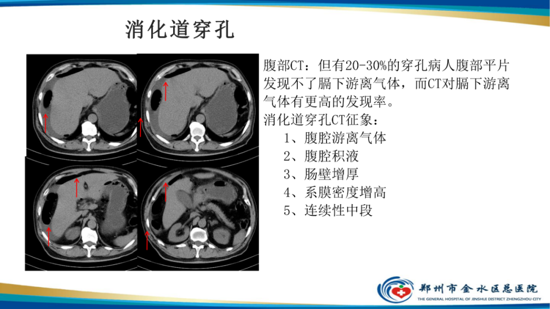 影像PPT - 【PPT】常见急腹症的影像学诊断-17