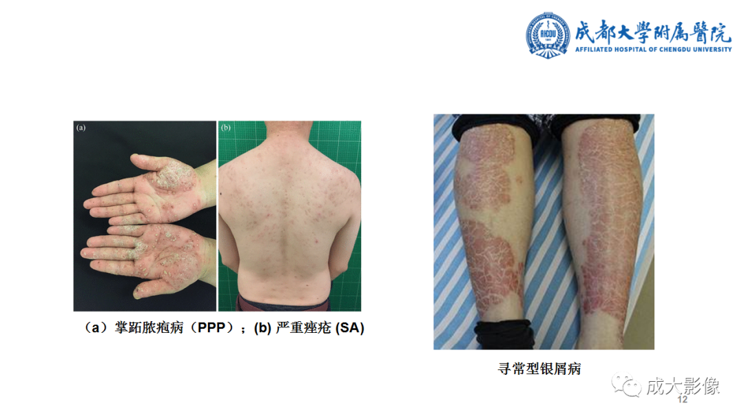 影像PPT - 【PPT】SAPHO综合征-12