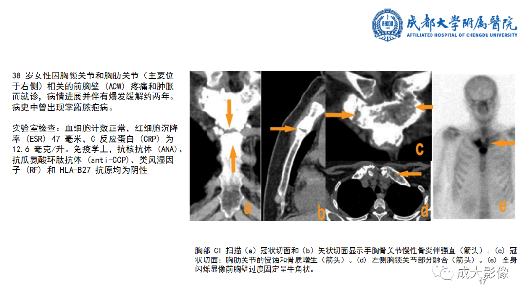 影像PPT - 【PPT】SAPHO综合征-17