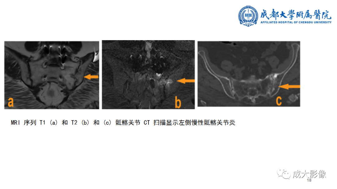影像PPT - 【PPT】SAPHO综合征-18
