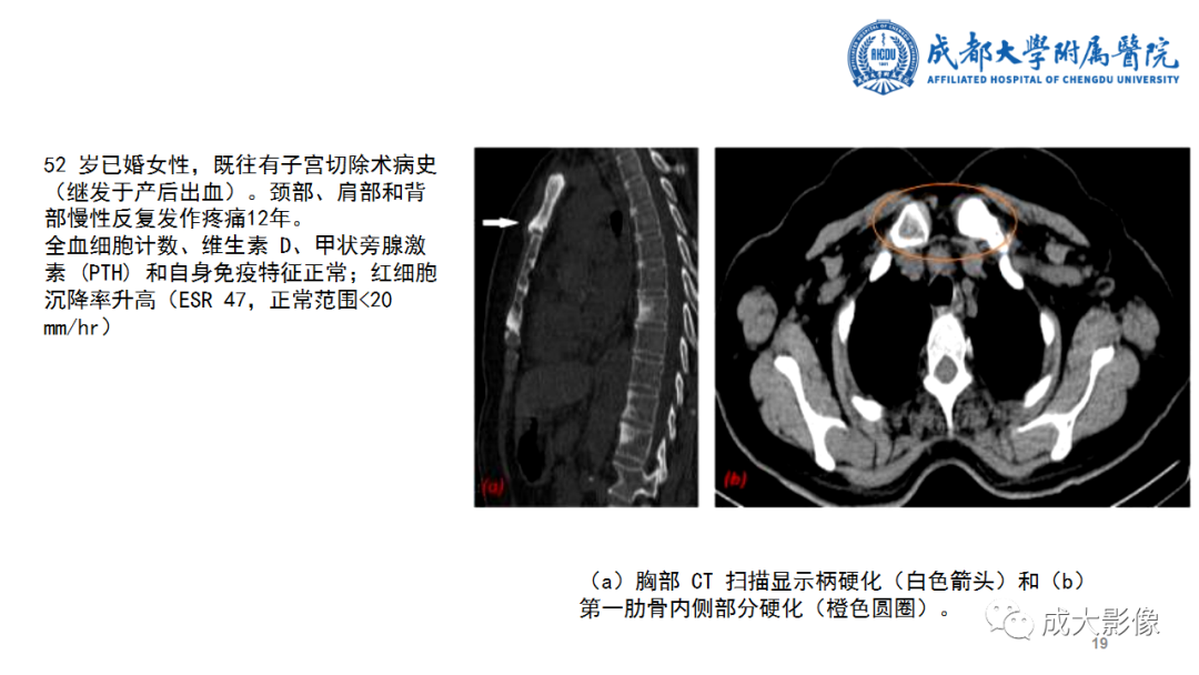 影像PPT - 【PPT】SAPHO综合征-19