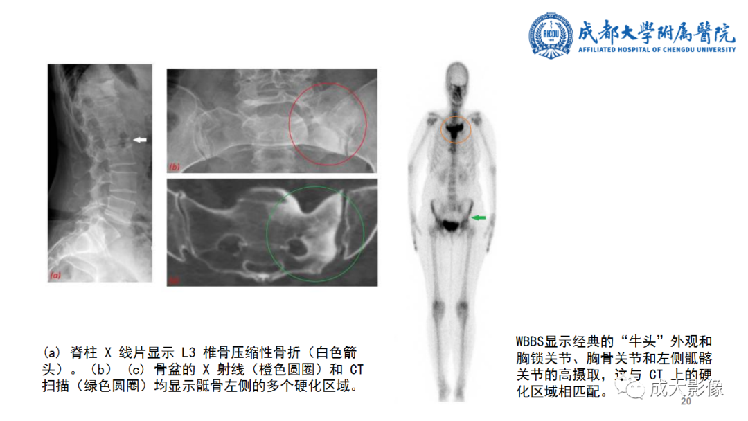 影像PPT - 【PPT】SAPHO综合征-20
