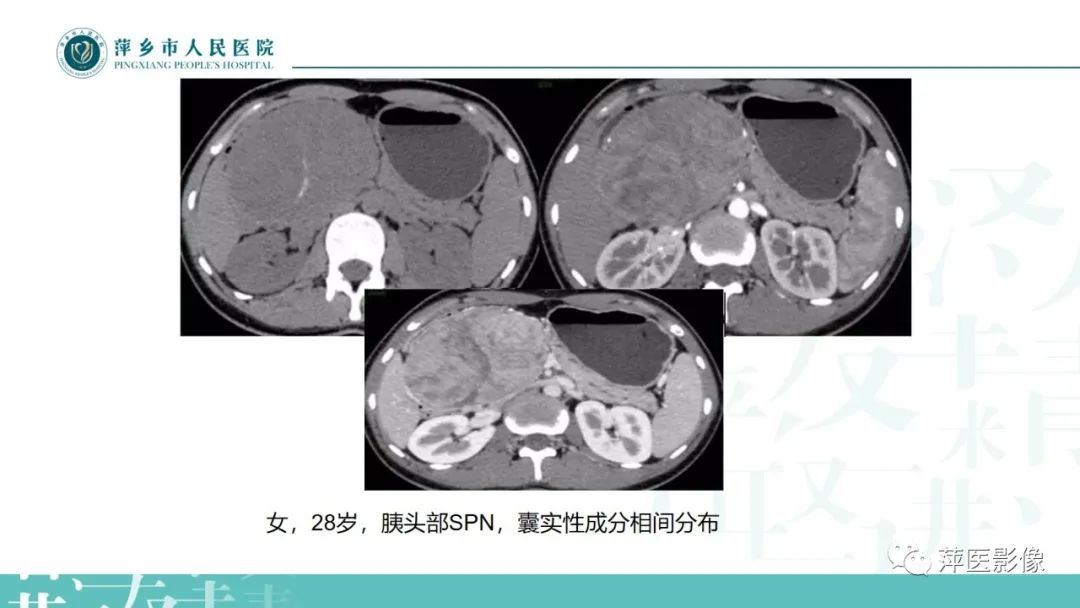 影像PPT - 【PPT】胰腺实性假乳头状瘤-10