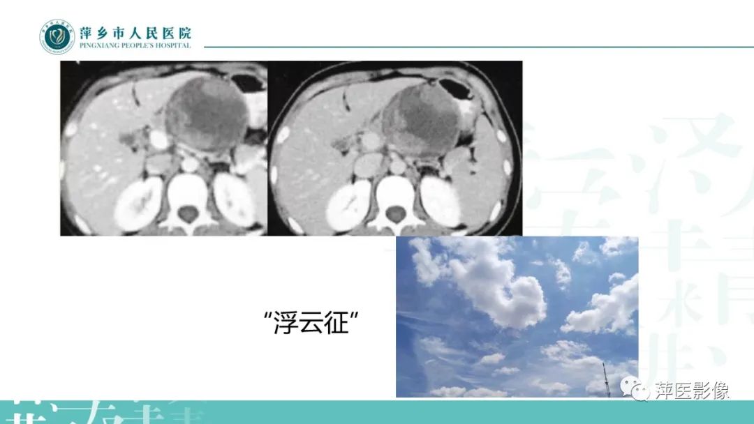 影像PPT - 【PPT】胰腺实性假乳头状瘤-11