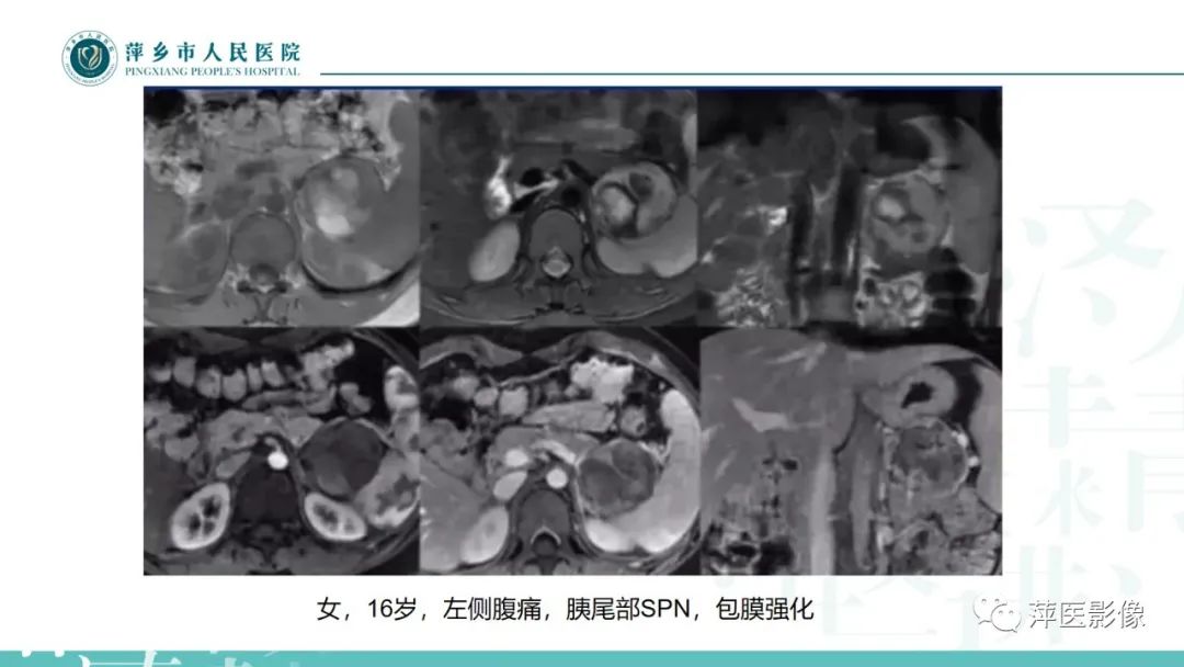 影像PPT - 【PPT】胰腺实性假乳头状瘤-12