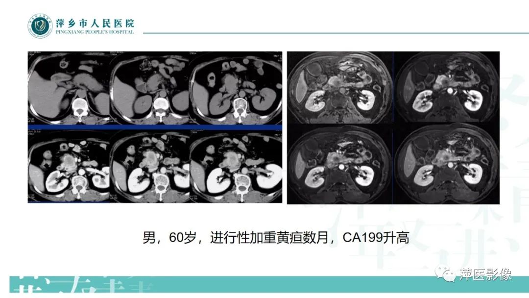 影像PPT - 【PPT】胰腺实性假乳头状瘤-16