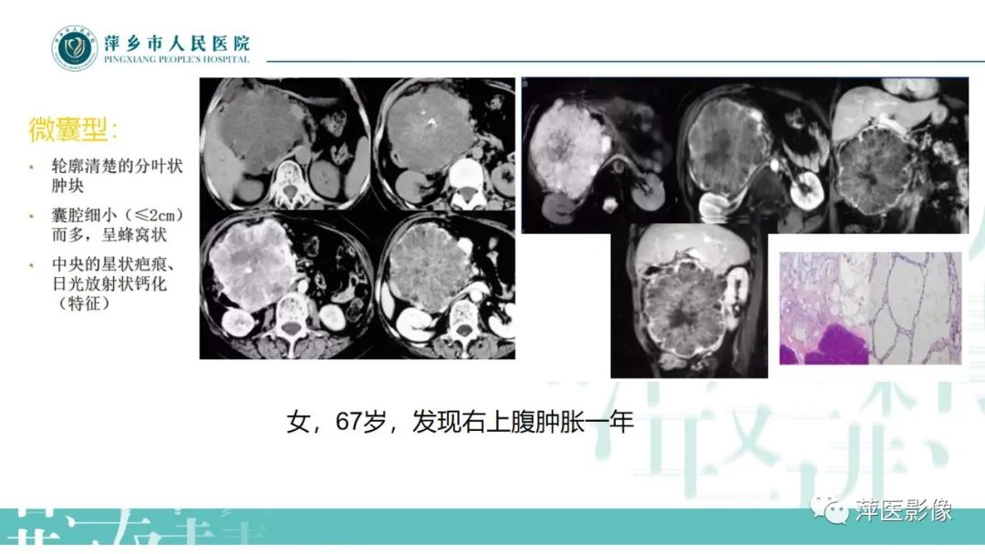 影像PPT - 【PPT】胰腺实性假乳头状瘤-19