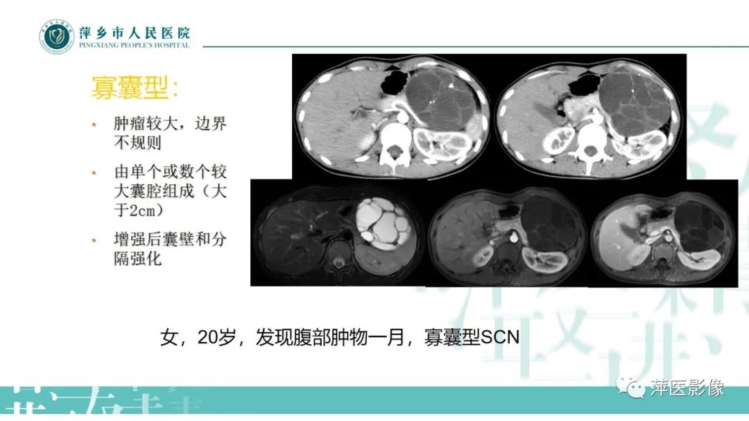 影像PPT - 【PPT】胰腺实性假乳头状瘤-20