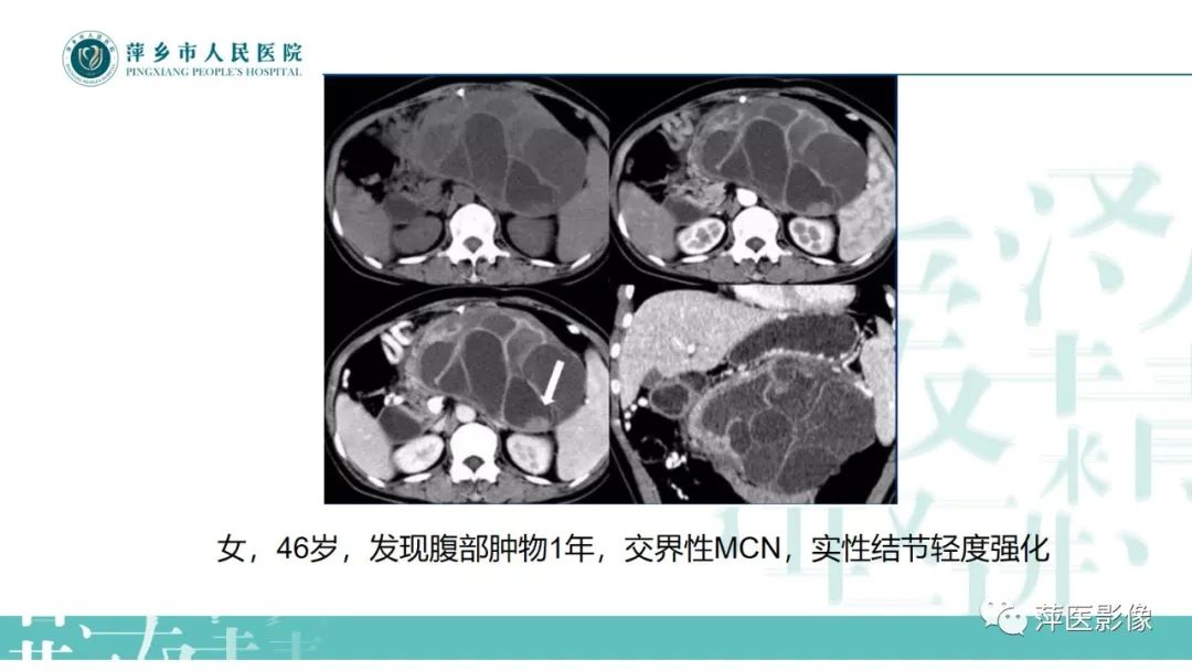 影像PPT - 【PPT】胰腺实性假乳头状瘤-22