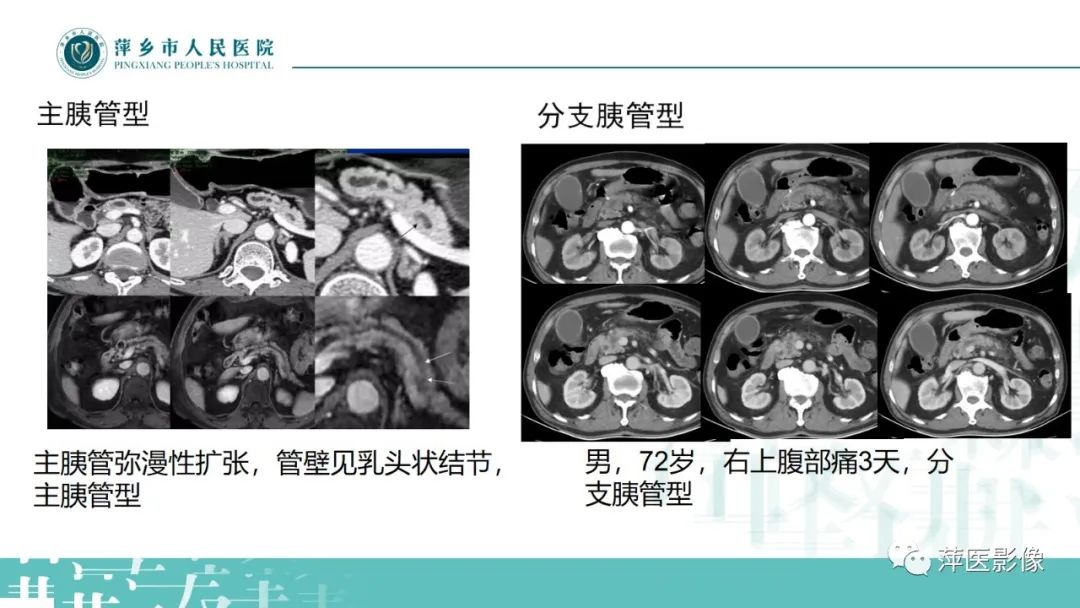 影像PPT - 【PPT】胰腺实性假乳头状瘤-24