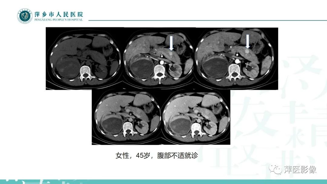 影像PPT - 【PPT】胰腺实性假乳头状瘤-27