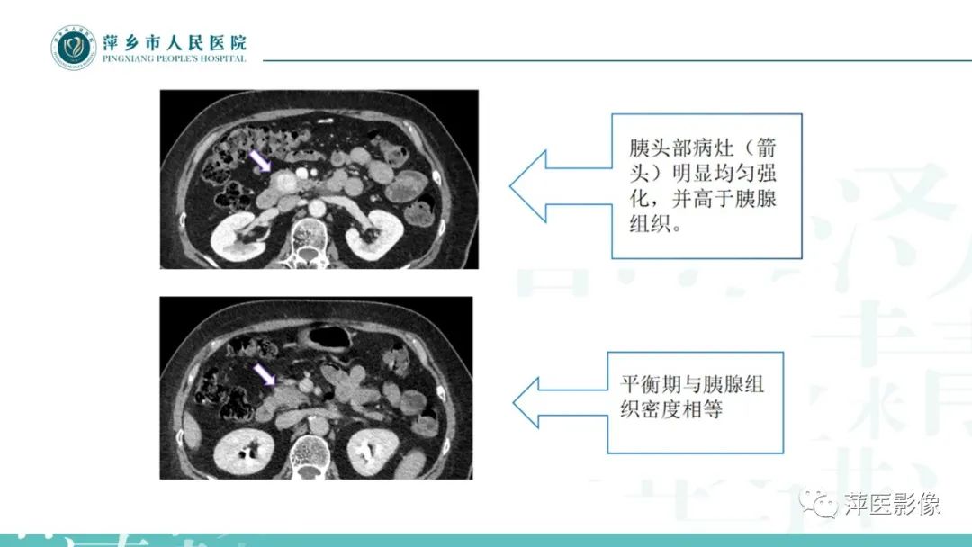 影像PPT - 【PPT】胰腺实性假乳头状瘤-28