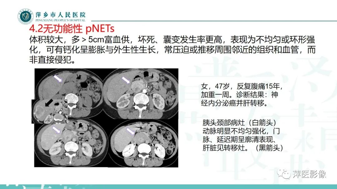 影像PPT - 【PPT】胰腺实性假乳头状瘤-29