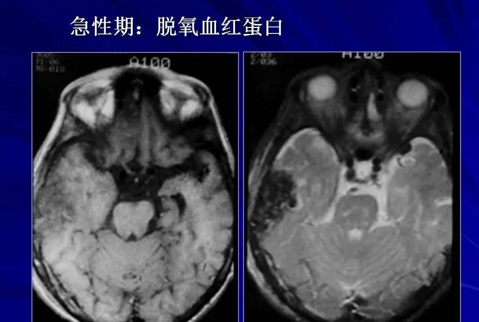 影像PPT - 【PPT】高血压脑血肿的CT、MRI表现及分期-35