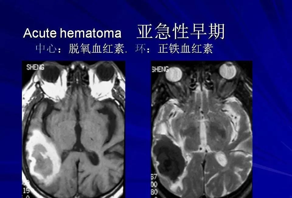 影像PPT - 【PPT】高血压脑血肿的CT、MRI表现及分期-36