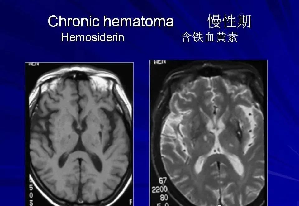 影像PPT - 【PPT】高血压脑血肿的CT、MRI表现及分期-41