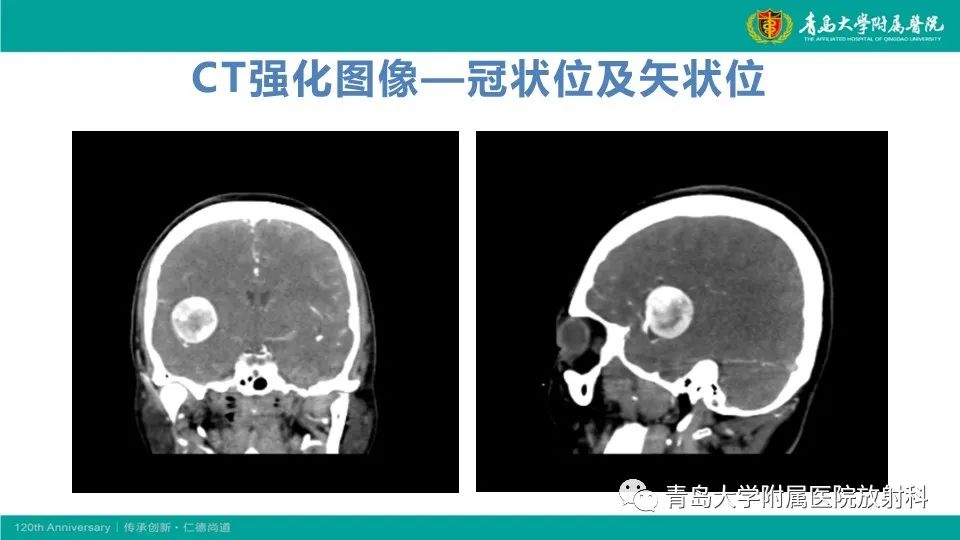 影像PPT - 【病例】颅内巨大动脉瘤1例CT及MR-5