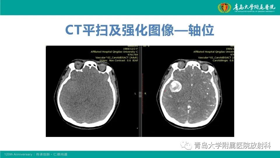 影像PPT - 【病例】颅内巨大动脉瘤1例CT及MR-4