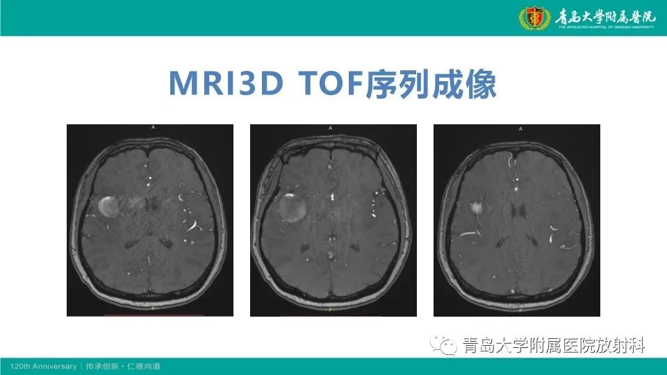 影像PPT - 【病例】颅内巨大动脉瘤1例CT及MR-6
